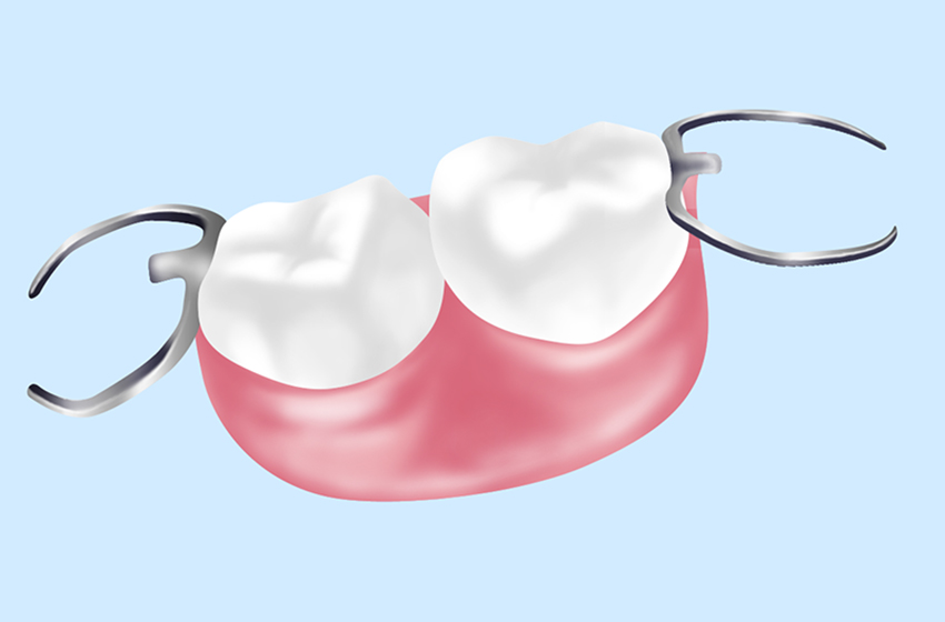 入れ歯治療の特徴