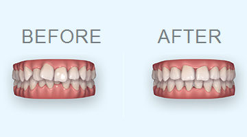 歯並びシミュレーション