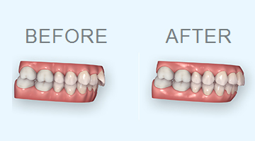 歯並びシミュレーション