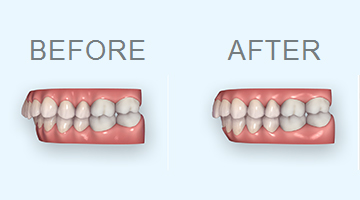 歯並びシミュレーション