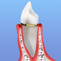 【軽度歯周炎】