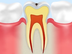 ごく初期のむし歯【CO】