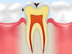 エナメル質のむし歯【C1】