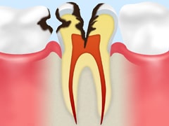 神経に達したむし歯【C3】