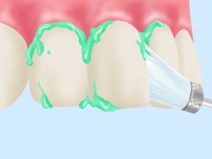 STEP2：歯のクリーニング